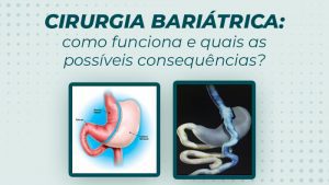 Cirurgia Bari Trica Como Funciona E Quais As Poss Veis Consequ Ncias