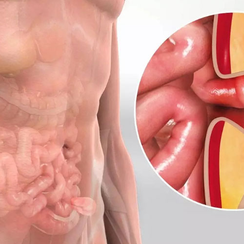 Quais tipos de cirurgia de hérnia inguinal e qual a melhor? – RR Médicos  Cirurgiões