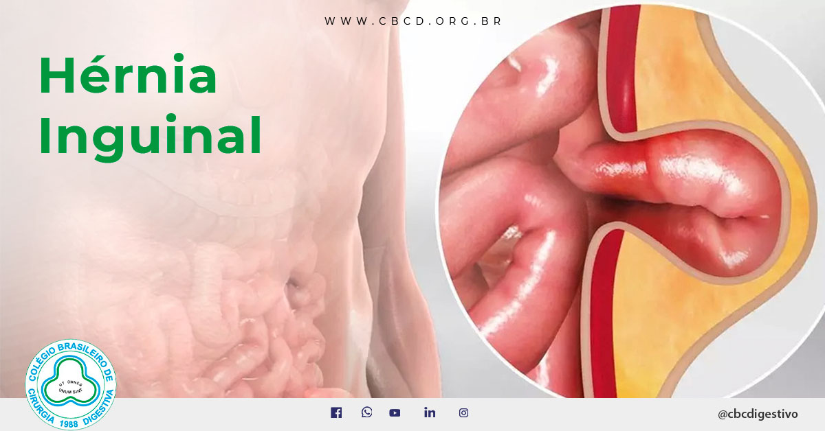 https://cbcd.org.br/wp-content/uploads/2021/11/hernia-inguinal-cbcd-fb.jpg