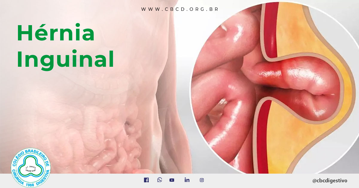 O que fazer no pós-operatório da hérnia inguinal - Hernia Clinic