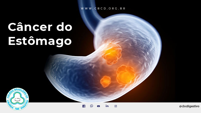 A imagem mostra uma ilustração digital de um estômago com bolinhas dentro que representam cânceres.