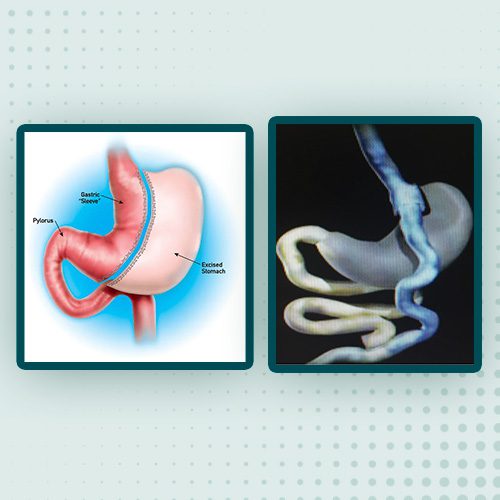 O que pode dar errado na Cirurgia de Hérnia Inguinal? • Café Cirúrgico